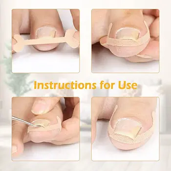 10 штук, Наклейка для регулировки вросшего ногтя на ноге для женщин и мужчин, Пластырь для ногтей